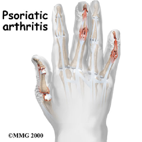 artrite psoriasica)